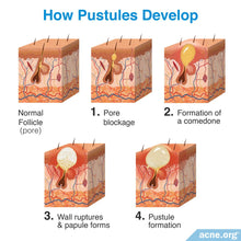 Load image into Gallery viewer, PUSTULE ACNE  SKINCARE SET