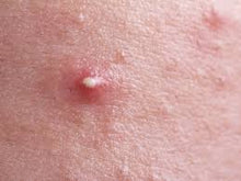 Load image into Gallery viewer, PUSTULE ACNE  SKINCARE SET